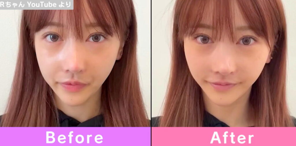Rちゃん 整形前 出典：アベマタイムズ